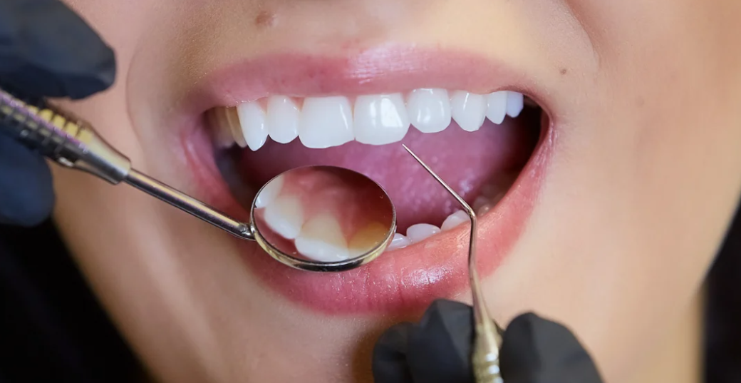 How Long Does Composite Bonding Last?